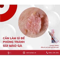 Loại bỏ mụn cóc sinh dục, sùi mào gà bằng kem bôi larifan ungo 1g.c( cam kết che sản phẩm khi giao).