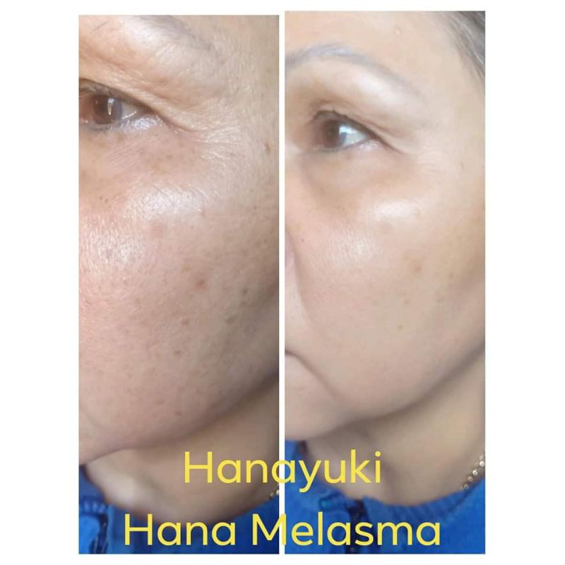 KEM MỜ  NÁM BAN ĐÊM HANA MELASMA & NIGHT MINI