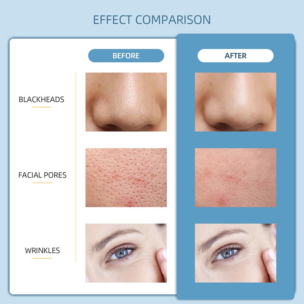 Máy làm sạch sâu lỗ chân lông FOREVERLILY bằng sóng siêu âm cổng sạc usb