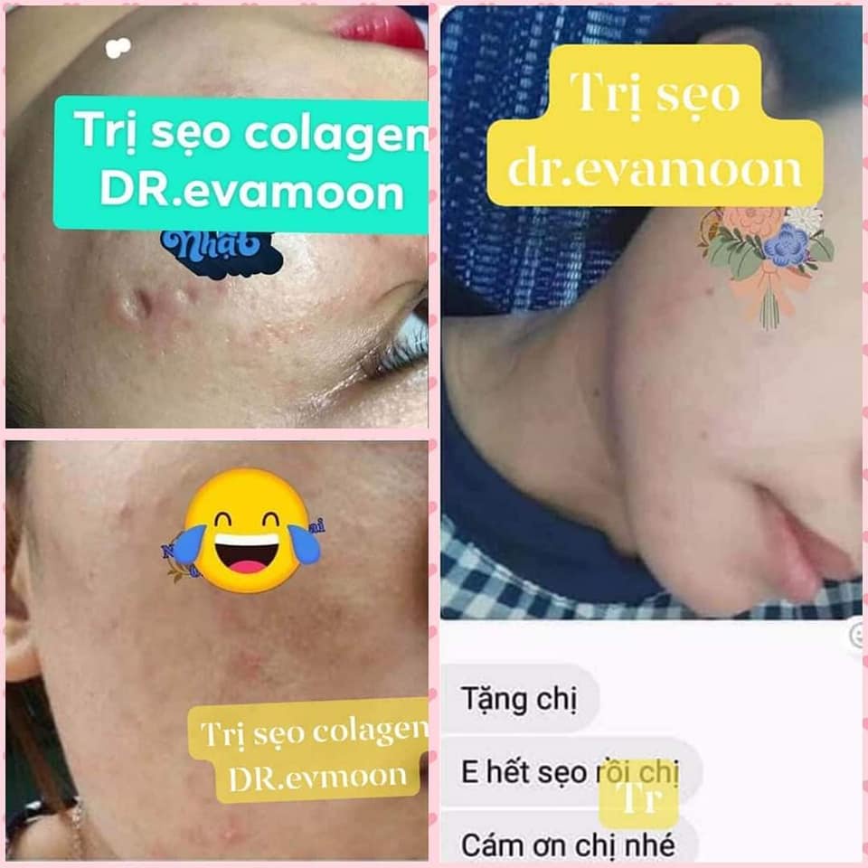 Kem Sẹo, Kem Sẹo Thâm, Rỗ Collagen Tươi Dr.EvaMoon