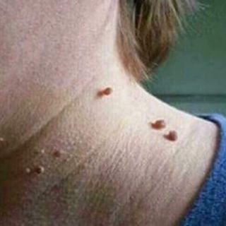 Gel tẩy nốt ruồi Nga