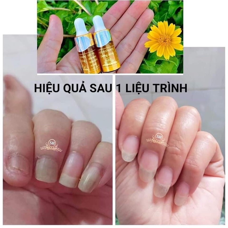 Liệu trình phục hồi nấm móng, hư khoé, bọng móng nước ăn chân.