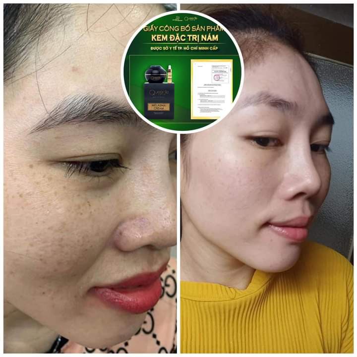 Kem nám Queenie Skin xoá mọi vết nám tàn nhang đốm nâu trên da( tặng kèm 1 chai serum mini)