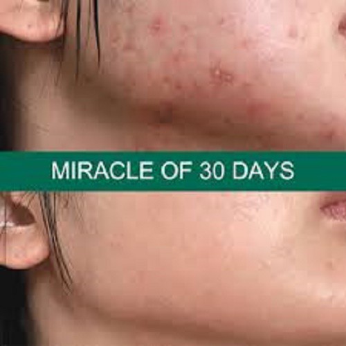 SERUM Cho Da Mụn Some By Mi AHA-BHA-PHA 30 Days Miracle Serum 50ml