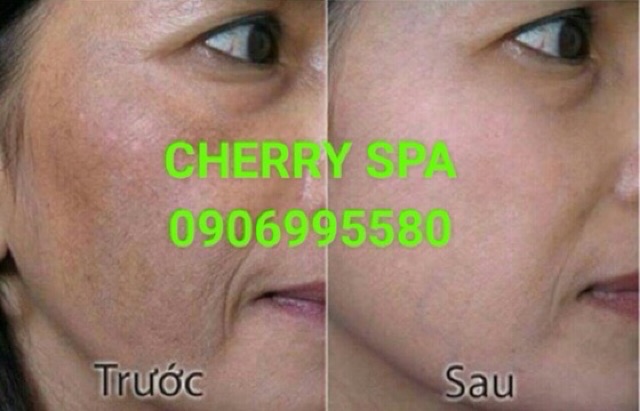 Kem dưỡng trắng ngừa tàn nhang đồi mồi vĩnh xuân