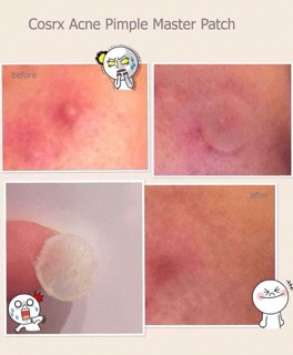 Miếng dán mụn Ance Cosrx
