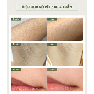 Máy Triệt Lông Cầm Tay Cá Nhân Cao Cấp
