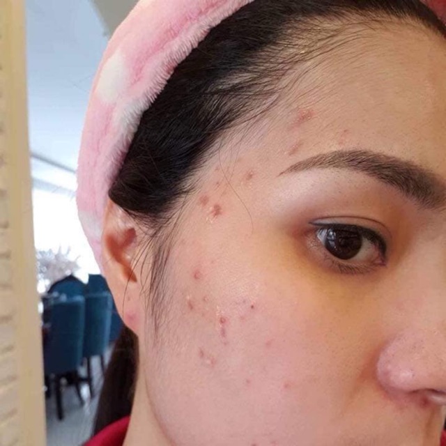 Hana Acnes - Hana Acnes White