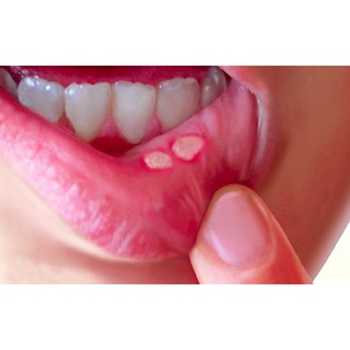 Kem bôi nhiệt miệng Peridex Hàn Quốc (mẫu mới nhất)