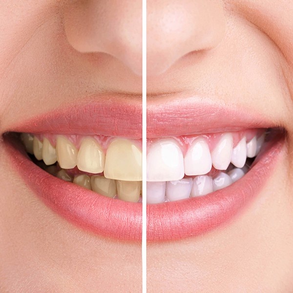 Full hộp 7 cặp - 14 miếng dán trắng răng 3D White Teeth Whitening Strips Bizstore