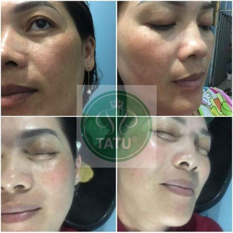 Kem nám trắng da S2 TATU CREAM MELASMA chiết xuất từ nhau thai cừu, collagen, cam thảo. 30Gr