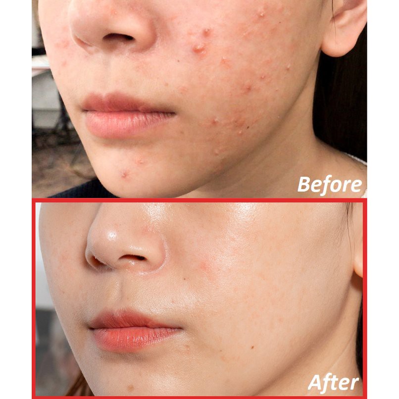 KEM SẸO KLIRVIN – NGA - Xóa Sẹo Mờ Thâm Nám Cấp Tốc- 25Gr | BigBuy360 - bigbuy360.vn