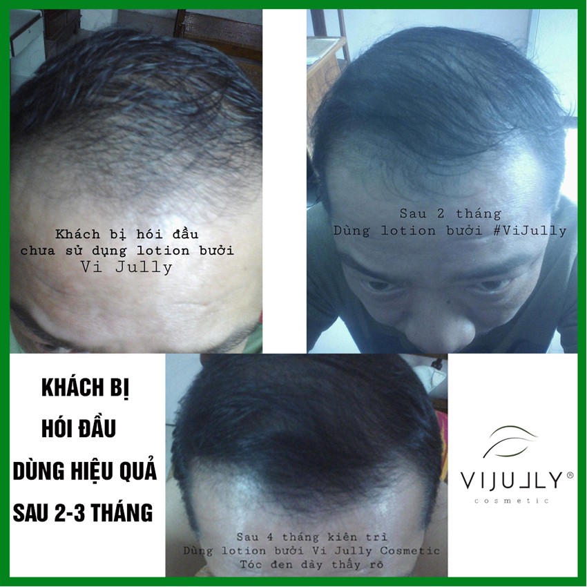 Bộ kích mọc tóc chuyên sâu gồm Dầu gội bưởi + Tinh dầu bưởi Vijully, giúp giảm rụng tóc, kích mọc tóc hiệu quả
