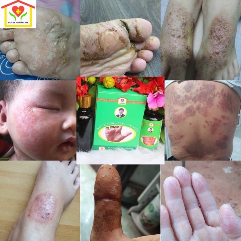 Tổ đỉa, chàm ngứa, chàm sữa, mẩn ngứa, ghẻ nước Ông Lam