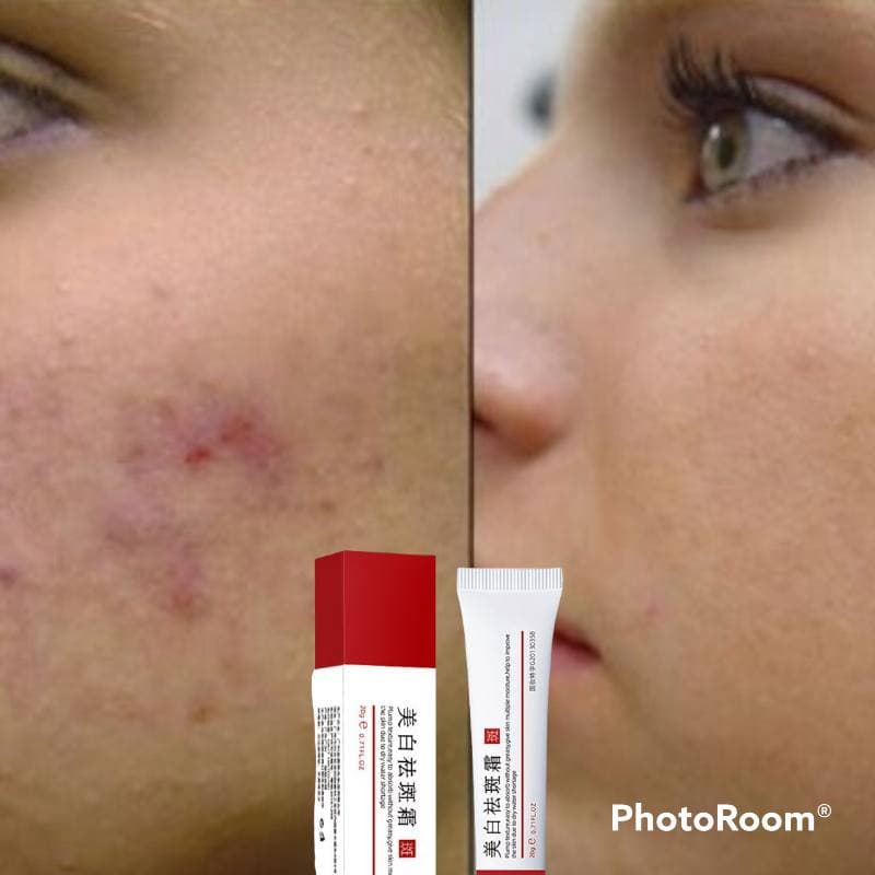 Kem giảm thâm mụn, làm mờ vết thâm, cải thiện sắc tố da Zuzu Cosmetic