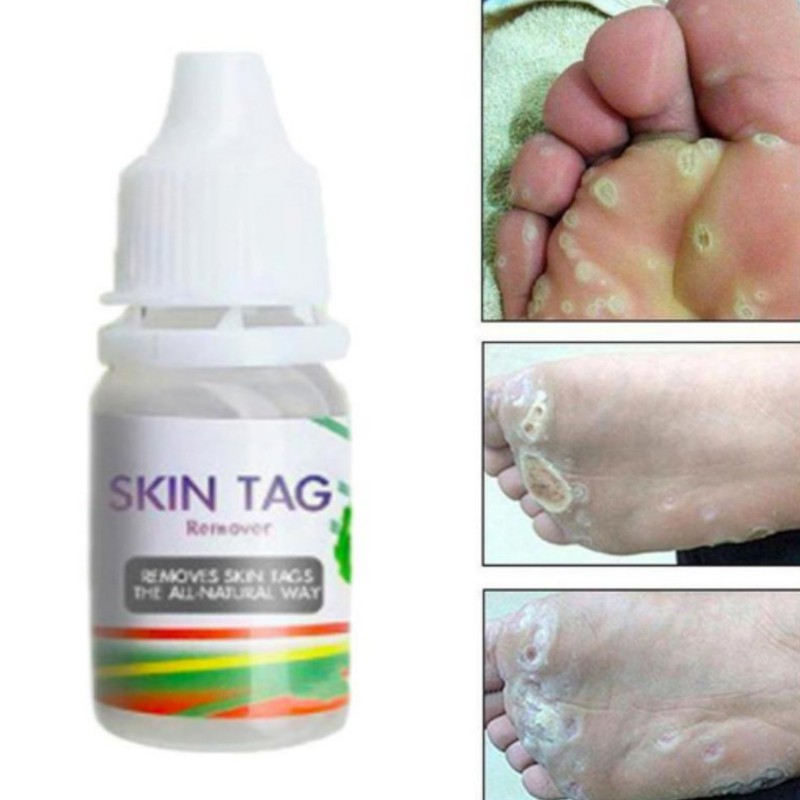 12 Hours Skin Tag Mole & Genital Wart Remover Foot Corn Removal 10Ml