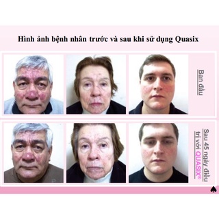 (Hàng công ty) Quasix dành cho mụn, đỏ da