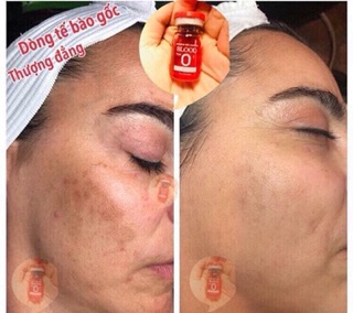 TẾ BÀO GỐC BLOOD O