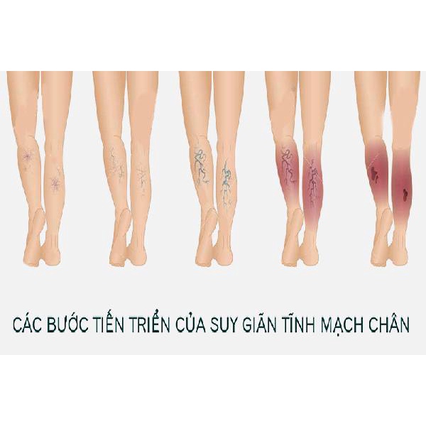 Kem Giãn Tĩnh Mạch VARIKOSETTE Nga,Cải Thiện Lưu Thông Máu Giữ Lại Vẻ Đẹp Cho Đôi Chân