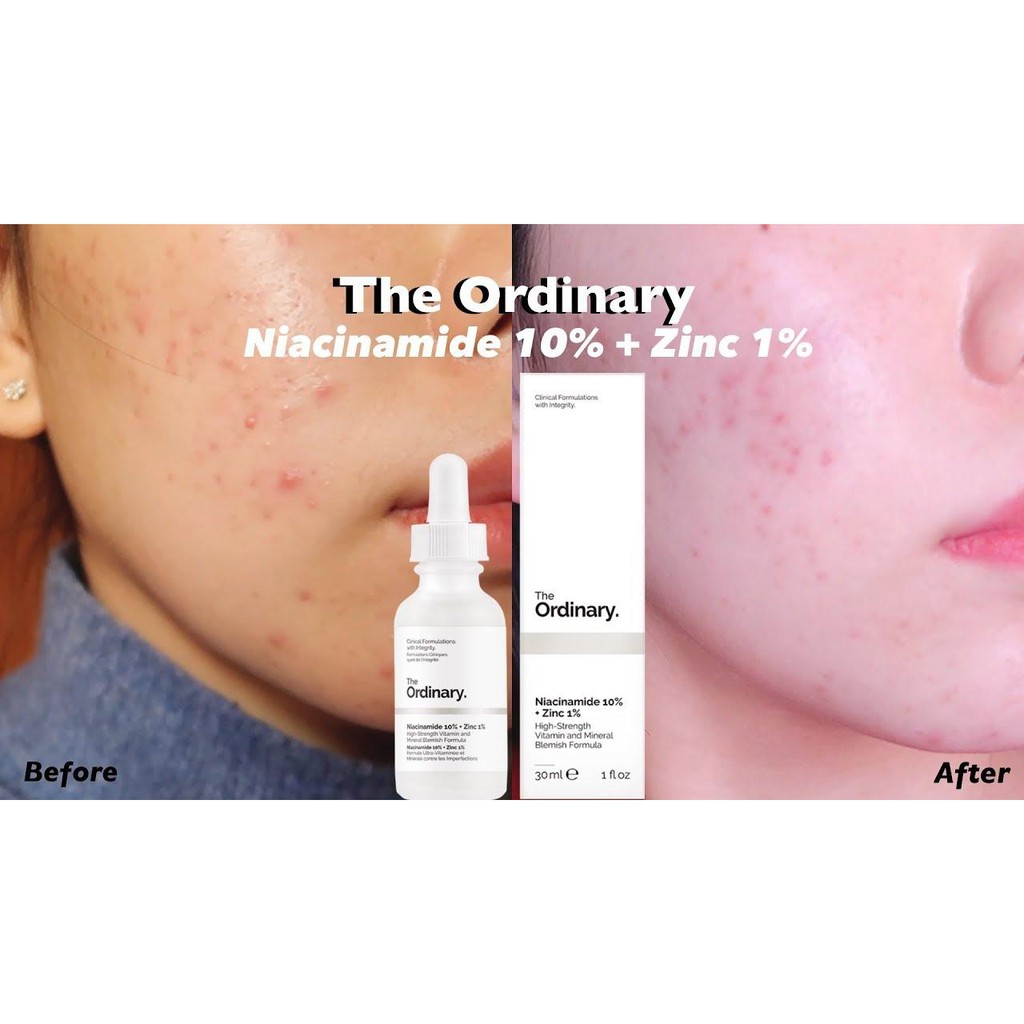 Tinh Chất Dưỡng Sáng Da The Ordinary Niacinamide 10% + Zinc 1% Serum