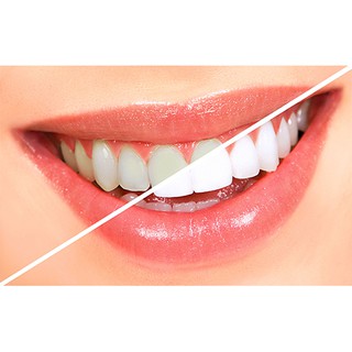 Miếng dán trắng răng Crest 3D White Professional Effects (set 5 Miếng)