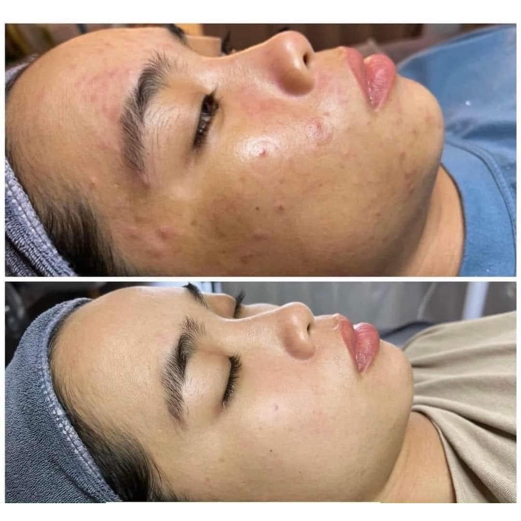 Bộ đôi serum detox mờ thâm nám mụn sáng da Treatmen Bright Kamel hàng chính hãng