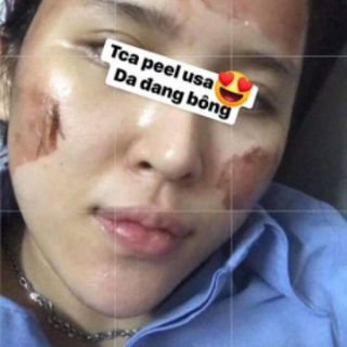 bộ mỹ phẩm thay da face tca usa