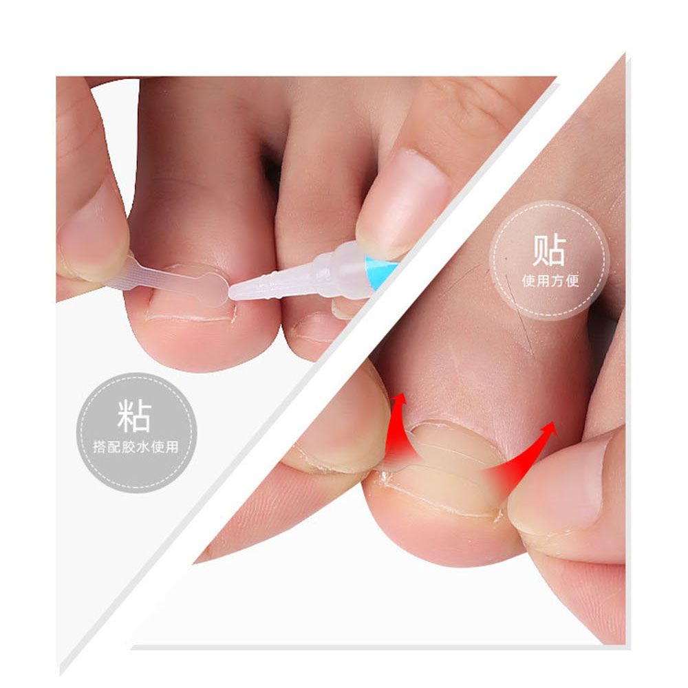 10 Miếng dán chỉnh sửa móng chân mọc ngược co giãn tự làm