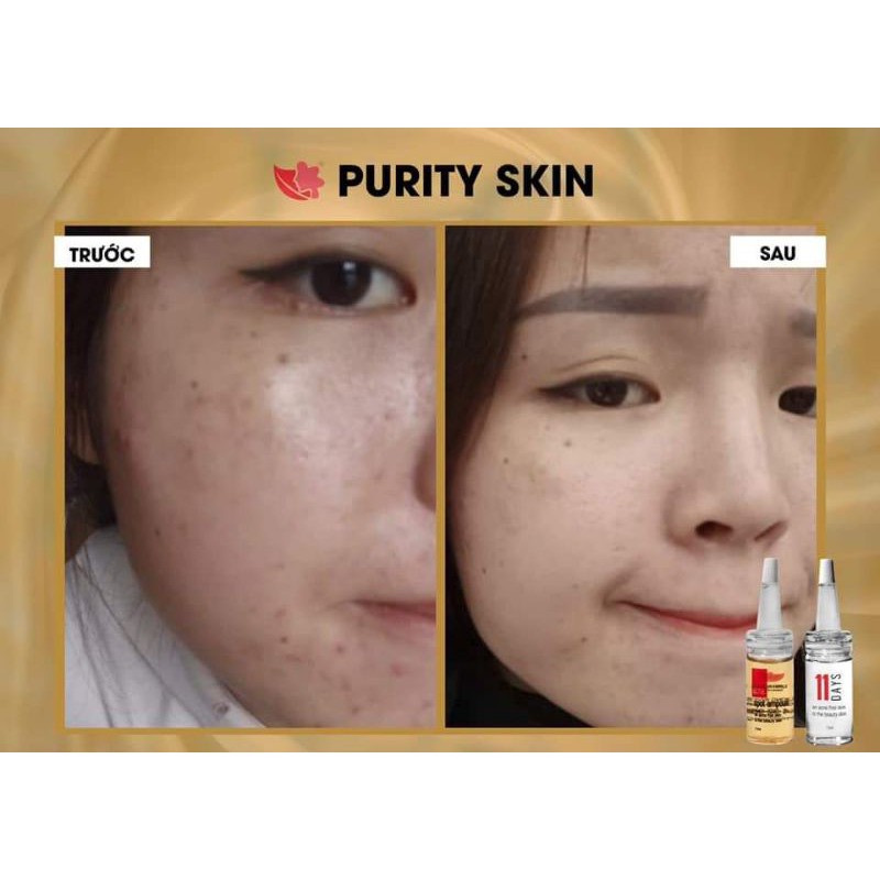 Tinh Chất Mụn PURITY SKIN Linh Hương Loại Bỏ Mọi Loại Mụn