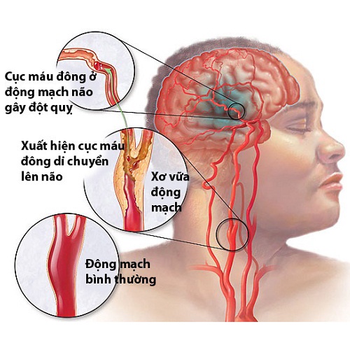 HT Strokend hỗ trợ Tai biến đột qụy não Giảm mỡ máu xơ vữa động mạch Làm tan cục máu đông Tăng tuần hoàn Tái tạo tế bào