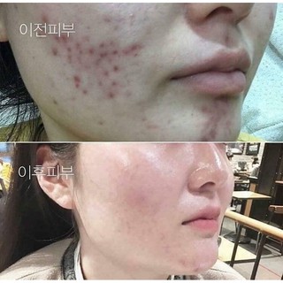 Red peel tingle serum- thay da căng bóng