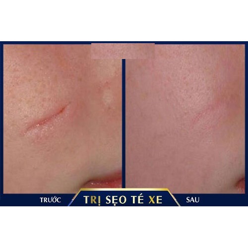 Scar Esthetique 4ml kem làm mờ sẹo thâm, sẹo rỗ, sẹo lõm REJUVASKIN