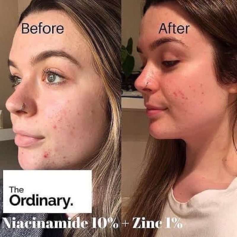 Tinh chất trị thâm mụn The Ordinary Niacinamide 10% + ZinC 1%