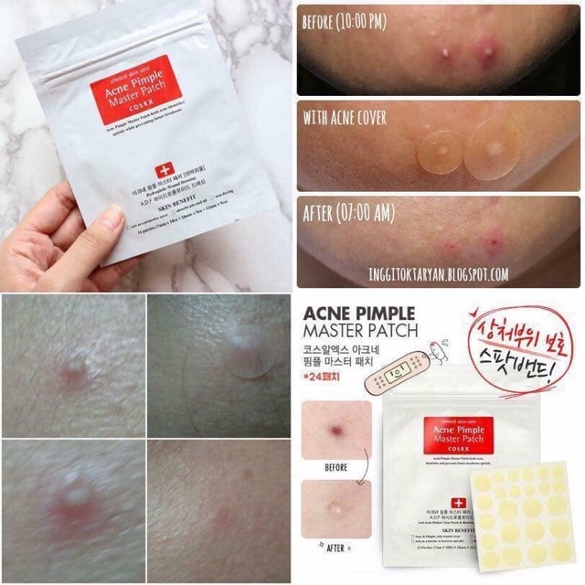 [COSRX]Miếng dán mụn - Cosrx Acne Pimple Master Patch