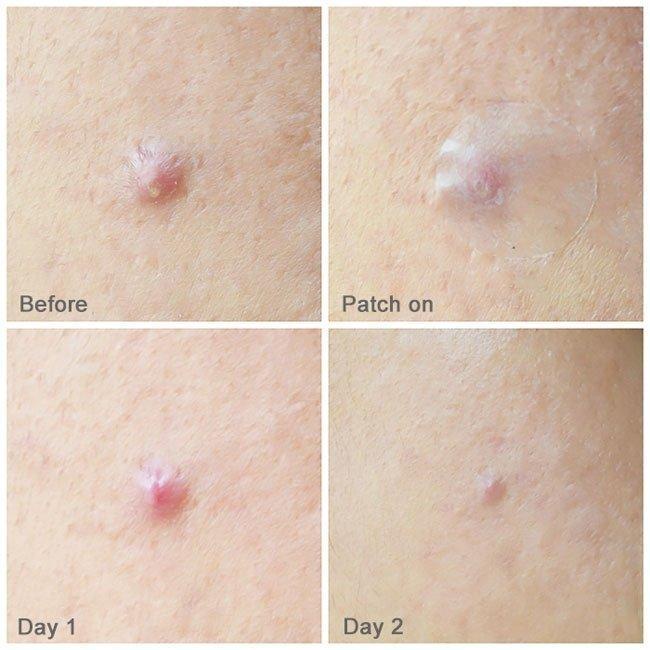 Miếng dán mụn Some By Mi Clear Spot Patch