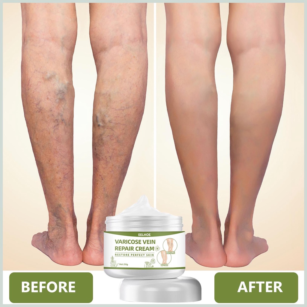 Kem Suy Giãn Tĩnh Mạch Perfect Skin 50g - Kem Varicose Vein Repair Cream Restore Thảo Dược Cải Thiện Tĩnh Mạch
