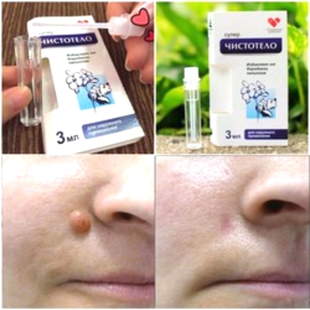 (CHÍNH HÃNG) T.ẩy Nốt Ruồi, Tàn Nhang, Mụn Cơm, Mụn Cóc của Nga Dvelinil Giúp Bạn Tự Tin Hơn