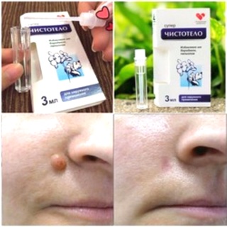 (CHÍNH HÃNG) T.ẩy Nốt Ruồi, Tàn Nhang, Mụn Cơm, Mụn Cóc của Nga Dvelinil Giúp Bạn Tự Tin Hơn