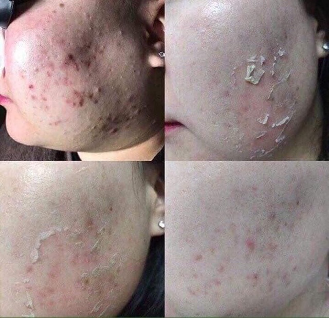 1 hộp btox peel 2 màu dùng trong spa thẫm mỹ viện