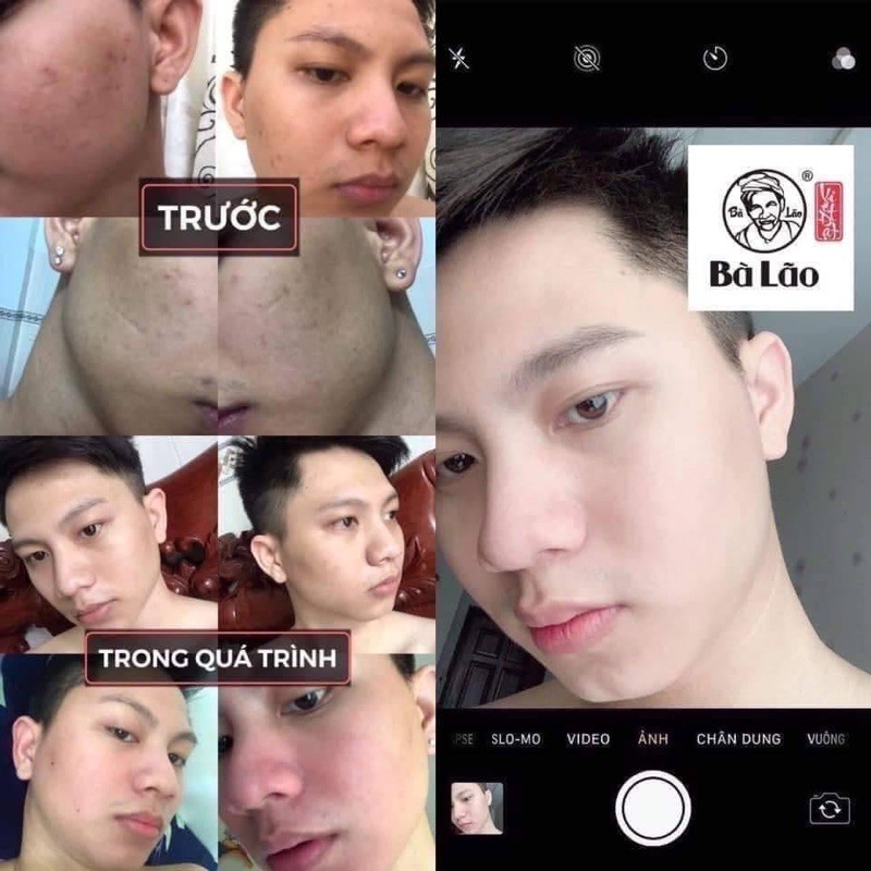 Serum Mụn Thâm Sẹo Nám Cao Cấp Bà Lão