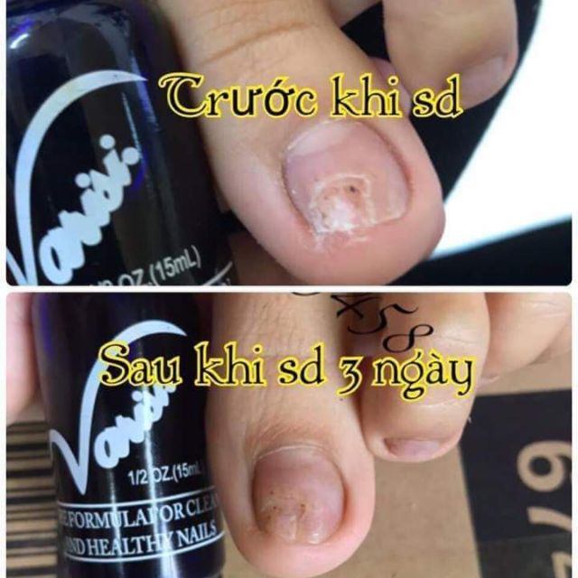 Combo sỉ 20 chai nấm móng