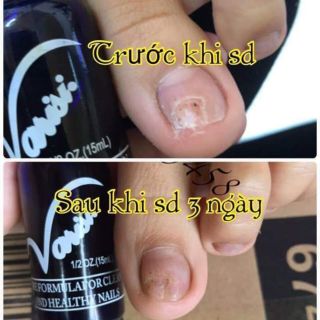 Combo sỉ 20 chai nấm móng