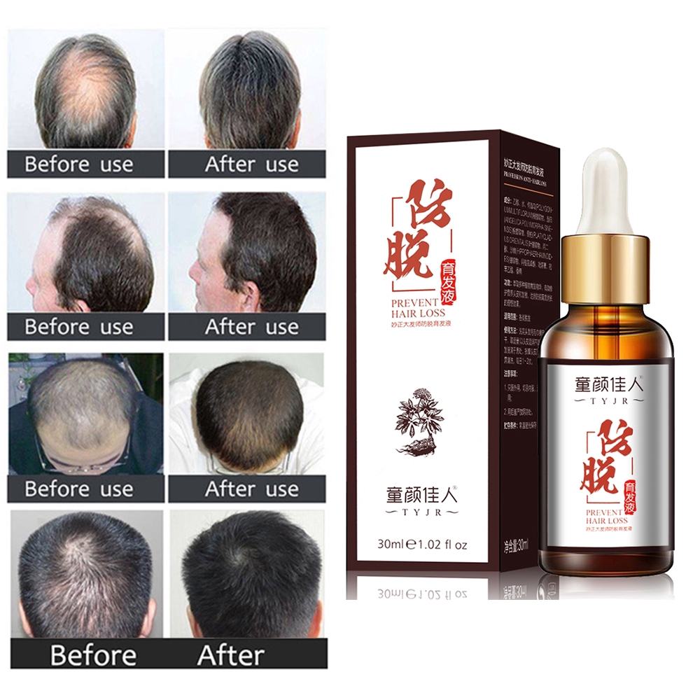 [Hàng mới về] Thuốc dưỡng tóc chống rụng tóc dung tích 30ml