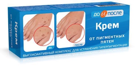 Kem trị đồi mồi tay chân KPEM