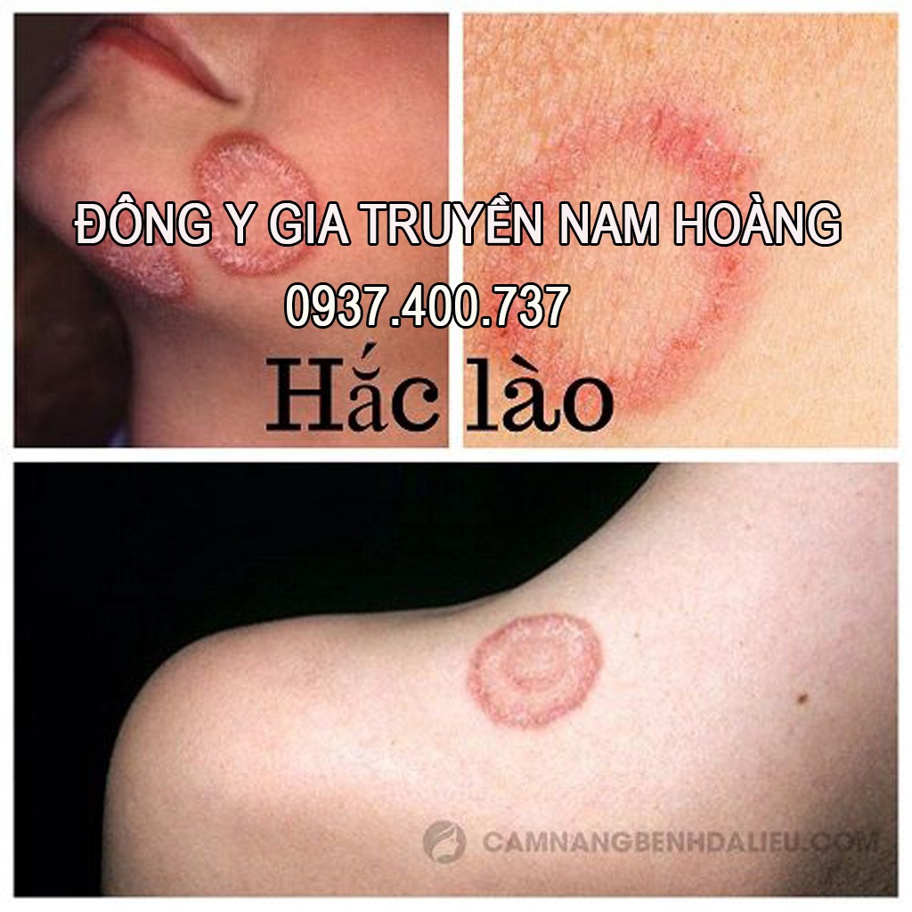 Cao Bôi Hắc Lào, Nấm Ngứa, Á Sừng, Lang Ben Nam Hoàng