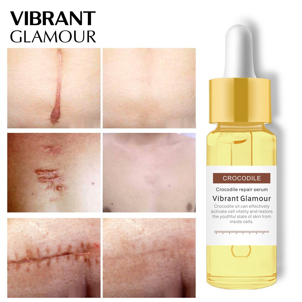 VIBRANT GLAMOUR Acne Scar Removal Serum Skin Repair Scar Essence Acne Treatment Cream Remove Stretch Marks Whitening Spots Reduce Appearance of Acne Scars, Marks, Wrinkles, and Dark Spots Shrink Pores Blackhead Skin Repair  15ml*4pcs