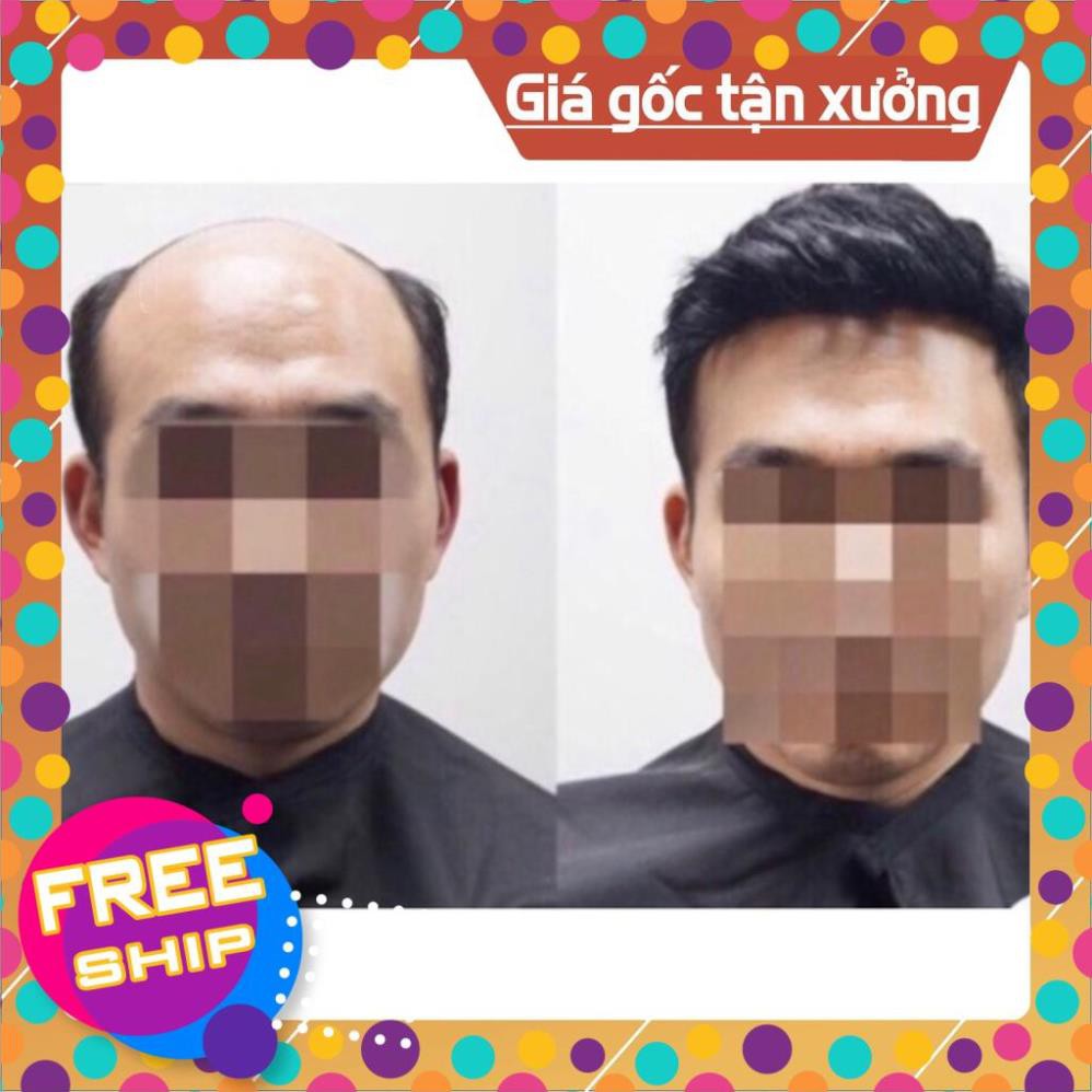 [FLASH SALE]  Tóc giả che hói nam  [SALE 20%]