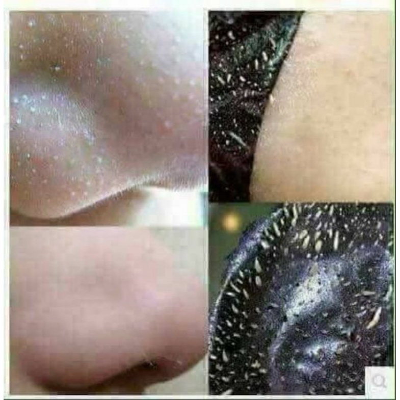 Gel Lột Mụn , Gel Hút Mụn Than Tre