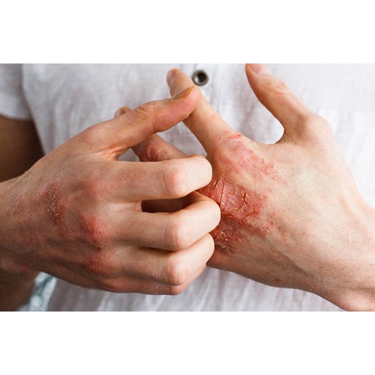 Thảo dược Bôi Hết Sạch Ghẻ nước, Ngứa, Rát, Bong tróc, Lột da, Nứt lẻ từng vùng từng mảng LUÔN SẴN CÓ