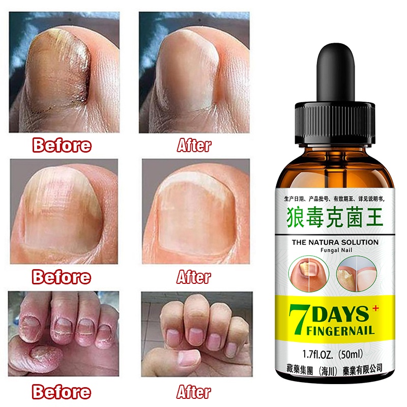 Tinh Chất Hỗ Trợ Giảm Bệnh Nấm Móng Chăm Sóc Móng Tay Tiện Dụng